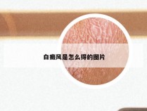 白癜风是怎么得的图片