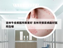 吉林牛皮癣医院那里好 吉林市银屑病最好医院在哪