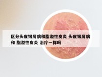 区分头皮银屑病和脂溢性皮炎 头皮银屑病 和 脂溢性皮炎 治疗一样吗