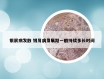 银屑病发散 银屑病发展期一般持续多长时间