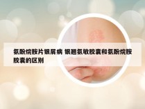 氨酚烷胺片银屑病 银翘氨敏胶囊和氨酚烷胺胶囊的区别