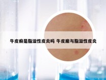 牛皮癣是脂溢性皮炎吗 牛皮廨与脂溢性皮炎
