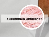 点状银屑病爆发治疗 点状银屑病的治疗