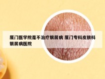 厦门医学院是不治疗银屑病 厦门专科皮肤科银屑病医院