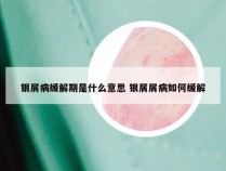 银屑病缓解期是什么意思 银屑屑病如何缓解