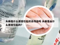 头癣是什么原因引起的会传染吗 头癣是由什么原因引起的?