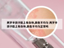 两岁半孩子脸上有白块,肤色不均匀 两岁半孩子脸上有白块,肤色不均匀正常吗
