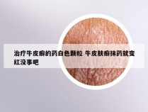 治疗牛皮癣的药白色颗粒 牛皮肤癣抹药就变红没事吧