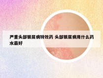 严重头部银屑病特效药 头部银屑病用什么药水最好