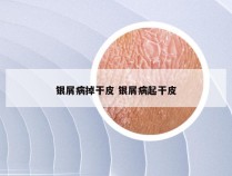 银屑病掉干皮 银屑病起干皮