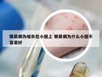 银屑病为啥长在小腿上 银屑病为什么小腿不容易好