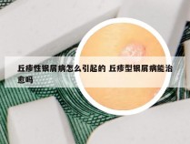 丘疹性银屑病怎么引起的 丘疹型银屑病能治愈吗