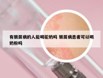 有银屑病的人能喝驼奶吗 银屑病患者可以喝奶粉吗