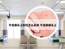 牛皮癣头上的坑怎么去掉 牛皮肤癣头上