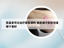 蒸桑拿可以治疗银屑病吗 银屑病汗蒸和泡澡哪个更好