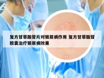 复方甘草酸苷片对银屑病作用 复方甘草酸苷胶囊治疗银屑病效果