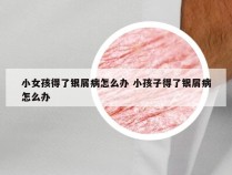 小女孩得了银屑病怎么办 小孩子得了银屑病怎么办