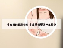 牛皮癣的辅助检查 牛皮肤癣要做什么检查