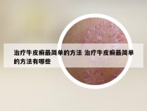 治疗牛皮癣最简单的方法 治疗牛皮癣最简单的方法有哪些