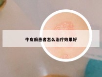 牛皮癣患者怎么治疗效果好