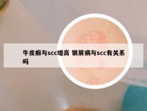 牛皮癣与scc增高 银屑病与scc有关系吗