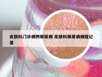皮肤科门诊病例银屑病 皮肤科银屑病病程记录