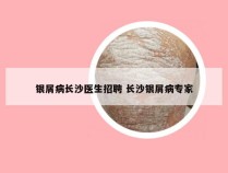 银屑病长沙医生招聘 长沙银屑病专家