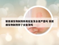 银屑病生物制剂停用后复发会更严重吗 银屑病生物制剂停了会复发吗
