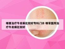 哪里治疗牛皮癣比较好专科门诊 哪家医院治疗牛皮癣比较好