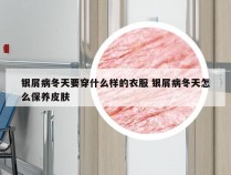 银屑病冬天要穿什么样的衣服 银屑病冬天怎么保养皮肤