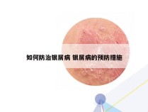 如何防治银屑病 银屑病的预防措施