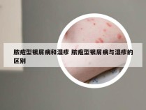 脓疮型银屑病和湿疹 脓疱型银屑病与湿疹的区别