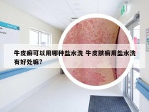 牛皮癣可以用哪种盐水洗 牛皮肤癣用盐水洗有好处嘛?