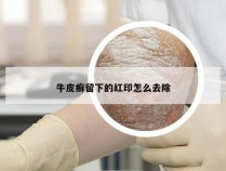 牛皮癣留下的红印怎么去除