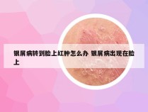 银屑病转到脸上红肿怎么办 银屑病出现在脸上