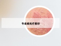 牛皮癣光疗黑印