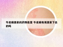 牛皮癣激素的药物危害 牛皮癣有用激素下去的吗
