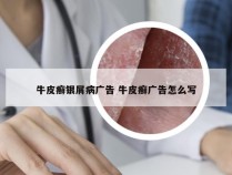 牛皮癣银屑病广告 牛皮癣广告怎么写