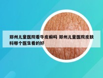 郑州儿童医院看牛皮癣吗 郑州儿童医院皮肤科哪个医生看的好