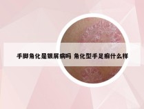 手脚角化是银屑病吗 角化型手足癣什么样