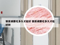 银屑病要吃多久才能好 银屑病要吃多久才能好转