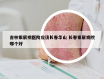 吉林银屑病医院应该长春华山 长春银屑病院哪个好
