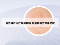 尚杰可以治疗银屑病吗 银屑病尚杰效果贴吧