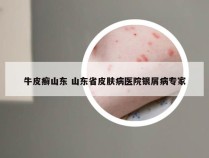 牛皮癣山东 山东省皮肤病医院银屑病专家