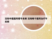 沈阳中医医院看牛皮癣 沈阳哪个医院治疗牛皮癣