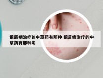 银屑病治疗的中草药有那种 银屑病治疗的中草药有那种呢