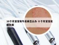 10个月宝宝有牛皮癣怎么办 十个月宝宝皮肤长癣