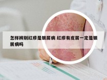 怎样辨别红疹是银屑病 红疹有皮屑一定是银屑病吗