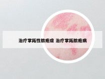 治疗掌跖性脓疱症 治疗掌跖脓疱病