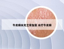 牛皮癣水光之家加盟 水疗牛皮癣